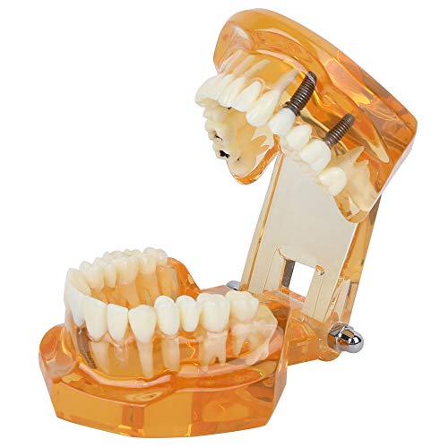 1 adet Şeffaf Hastalığı Diş Modeli,turuncu Renk,diş Hekimi Standart Hastalığı Çıkarılabilir Diş Patolojik Öğretim Modeli Gösteriler
